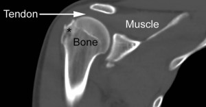 CT scan showing shoulder injury
