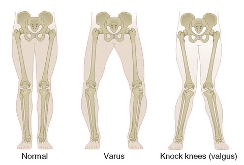 knee alignment in osteoarthritis 