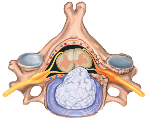 cervical spine disc herniation 