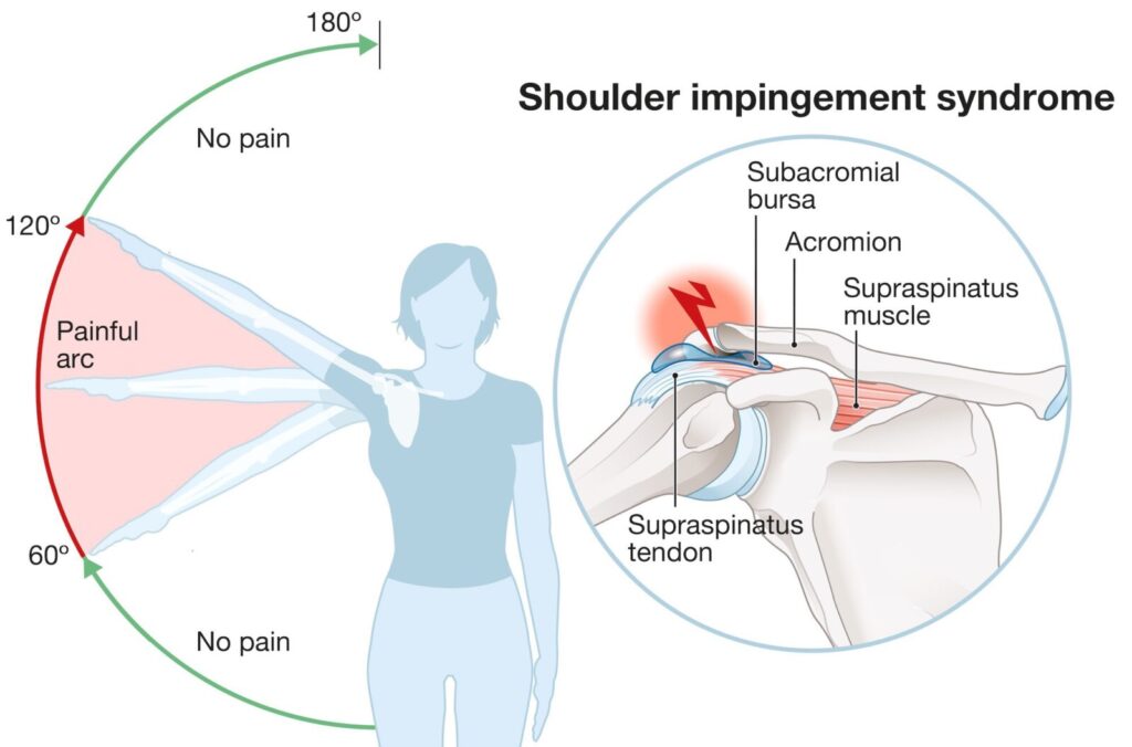 what is shoulder impingement